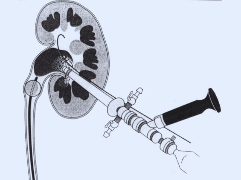 perkutan-nefrolitotripsi