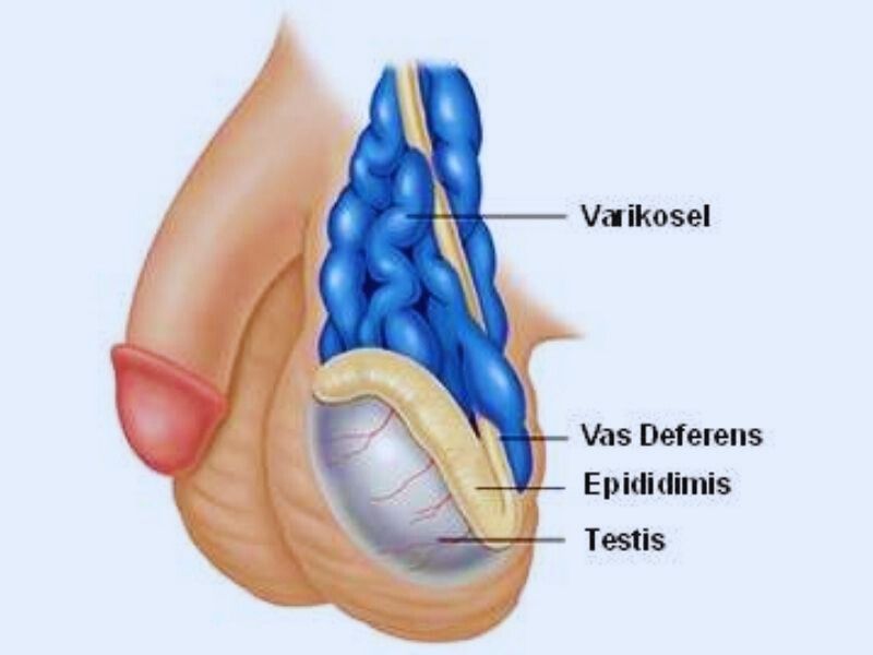 varikosel-ve-mikrocerrahi-varikoselektomi